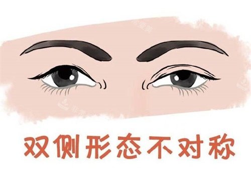 双眼皮不对称示意图 双眼皮不对称示意图
