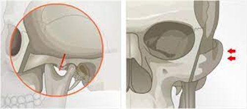 顴骨整形手術(shù)示意圖