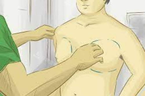 男性乳房發(fā)育癥手術示意圖