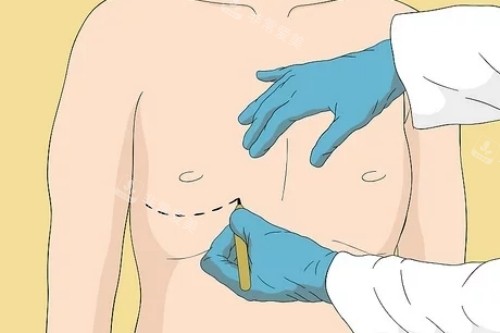 男性乳房发育症手术图示