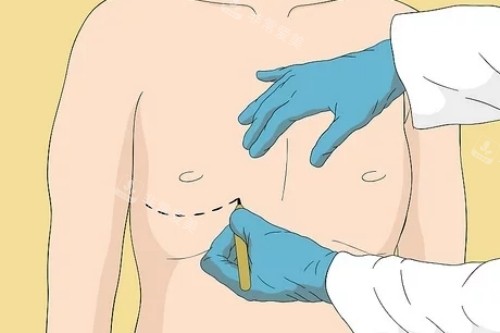 男性乳房發(fā)育癥手術圖示