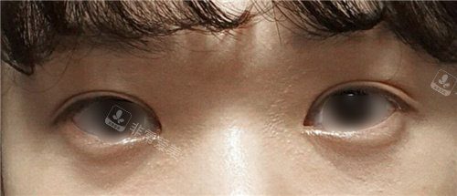 韩国原辰整形外科双眼皮手术后