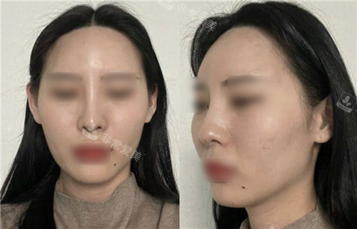 韓國原辰整形外科輪廓手術(shù)前后對比