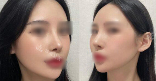 韓國原辰整形外科輪廓手術(shù)后