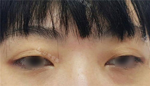 韩国原辰整形外科双眼皮手术前