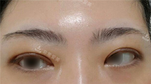 韩国原辰整形外科双眼皮手术后变化