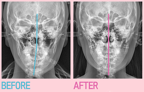 韩国菲斯莱茵整形医院双鄂轮廓手术对比CT