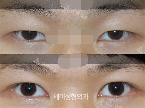 韩国世美整形医院双眼皮示意图