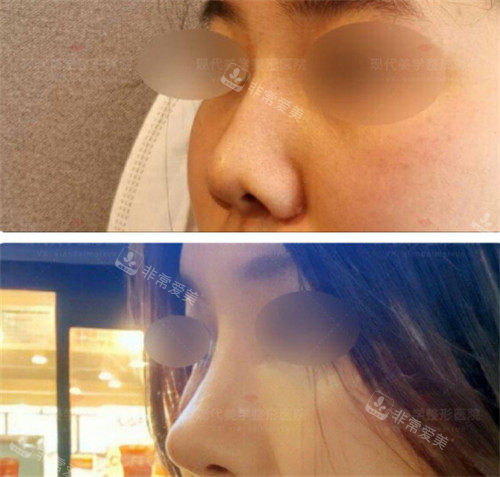 韩国现代美学整形外科鼻部整形前后图