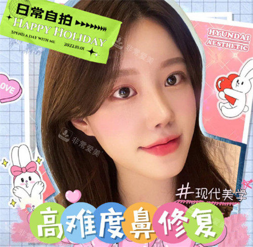 韓國(guó)現(xiàn)代美學(xué)整形外科鼻部整形術(shù)后照 韓國(guó)現(xiàn)代美學(xué)整形外科鼻部整形術(shù)后照