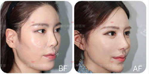 韩国现代美学整形外科轮廓三件套前后图