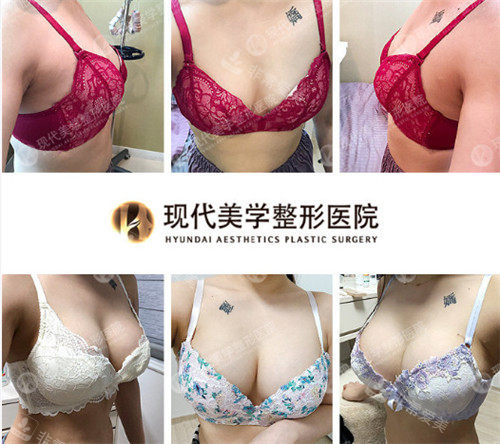 韓國(guó)現(xiàn)代美學(xué)整形外科隆胸前后對(duì)比照 韓國(guó)現(xiàn)代美學(xué)整形外科隆胸前后對(duì)比照