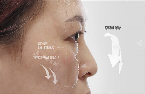 韩国大眼睛整形外科下眼睑提升术术前