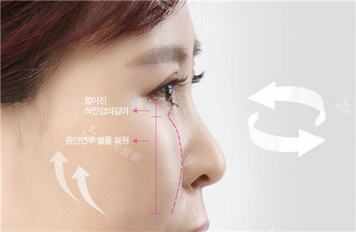 韩国大眼睛整形外科下眼睑提升术术后