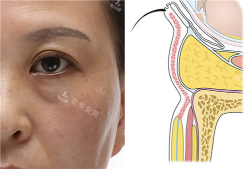 韩国大眼睛整形外科下眼睑提升术原理展示