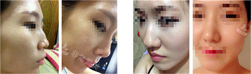 韩国will整形鼻子手术图片