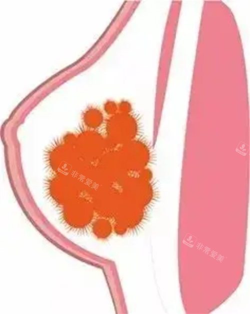 胸部奧美定示意圖 胸部奧美定示意圖