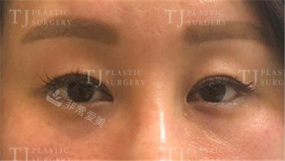 韩国TJ整形眼部手术前照片