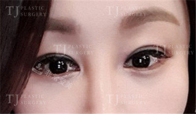 韓國(guó)TJ整形眼睛整形照片 韓國(guó)TJ整形眼睛整形照片