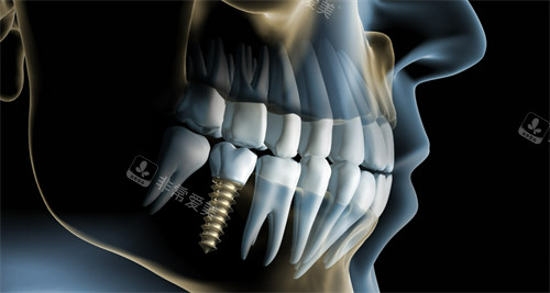 单颗种植牙图示