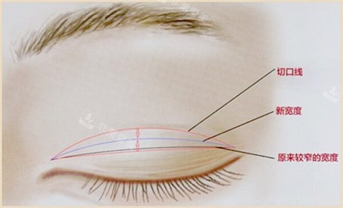 韩国可来熙眼修复技术好吗？眼角修复双眼皮修复特别好！