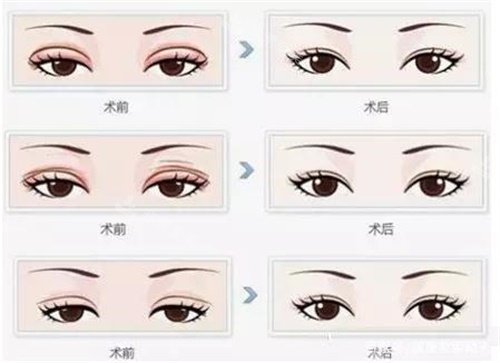 眼修復(fù)術(shù)前術(shù)后對(duì)比圖