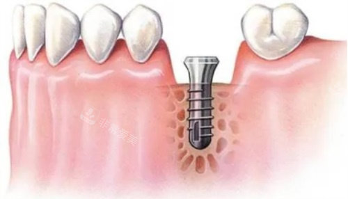 种植牙示意图