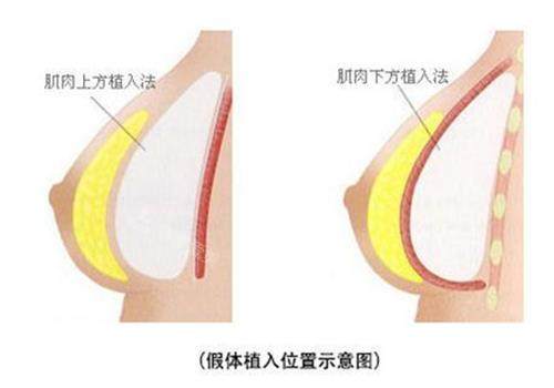 假體隆胸示意圖