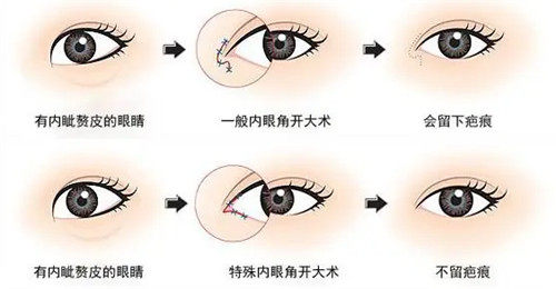 内眼角整形手术步骤图