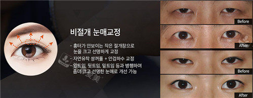 韩国will整形眼睑提升手术图