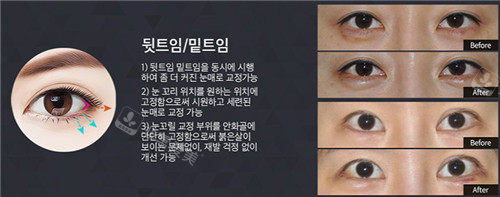 韩国will整形眼角手术图