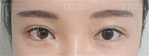 韩国TJ整形外科开眼角修复术前图