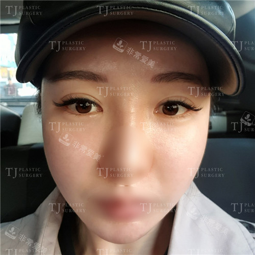韩国TJ整形外科眼角修复术后图