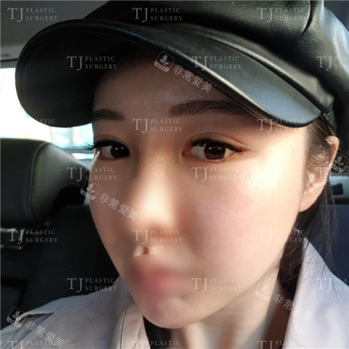 韩国TJ整形外科眼角修复术后侧面照