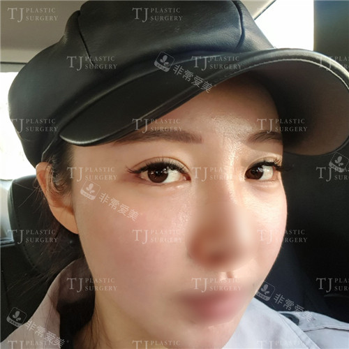 韩国TJ整形外科眼角修复手术术后图片