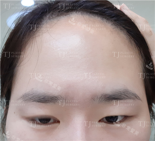 TJ整形外科自然黏连双眼皮手术术前照片
