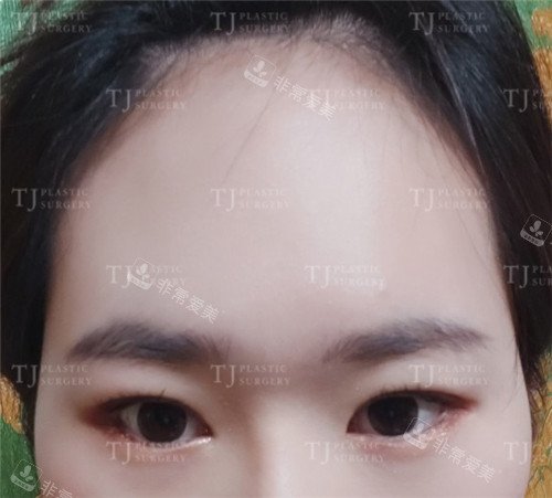TJ整形外科自然黏連雙眼皮手術(shù)術(shù)后照片 TJ整形外科自然黏連雙眼皮手術(shù)術(shù)后照片