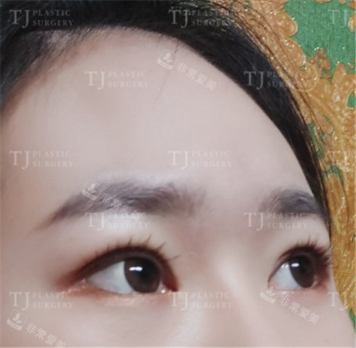 TJ整形外科自然黏連雙眼皮手術(shù)術(shù)后側(cè)面 TJ整形外科自然黏連雙眼皮手術(shù)術(shù)后側(cè)面
