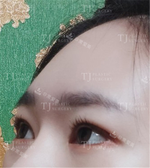 TJ整形外科自然黏連雙眼皮手術(shù)眼睛照片 TJ整形外科自然黏連雙眼皮手術(shù)眼睛照片