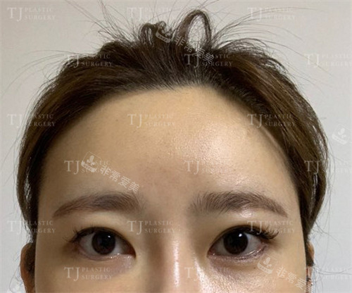 韩国TJ整形外科眼部整形术前图