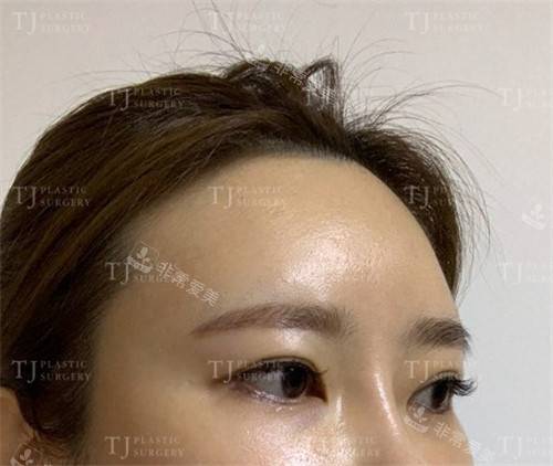 韩国TJ整形外科眼部整形术前照片