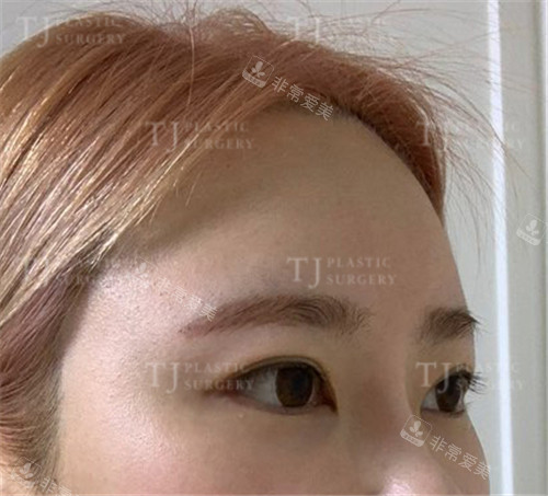 韩国TJ整形外科眼部整形术后侧面照片