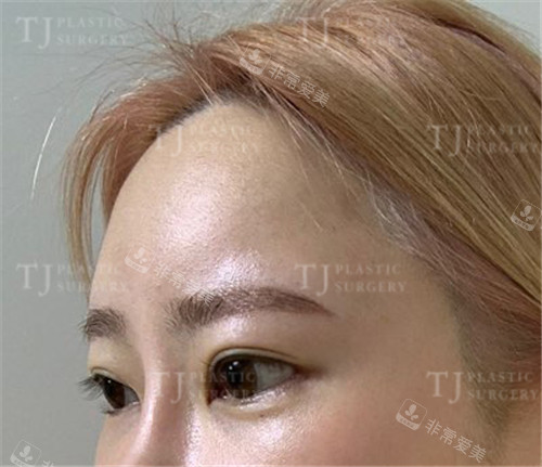 韩国TJ整形外科眼部整形术后眼睛图片
