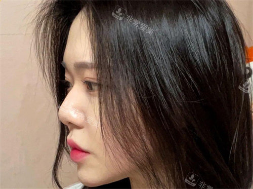 韓國優(yōu)雅人整形術(shù)前側(cè)面照