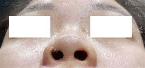 韓國(guó)TJ整形外科術(shù)前俯拍照 韓國(guó)TJ整形外科術(shù)前俯拍照
