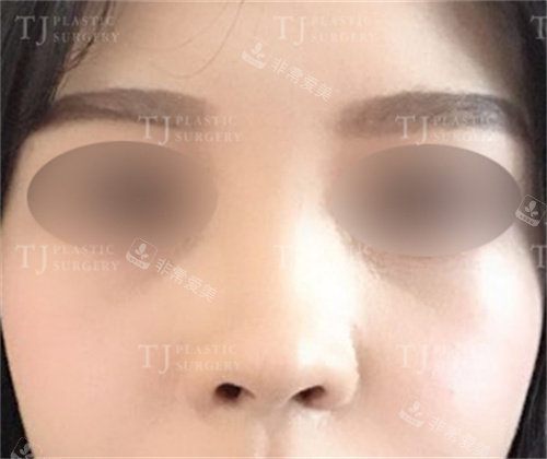 韩国TJ整形外科术前鼻翼图