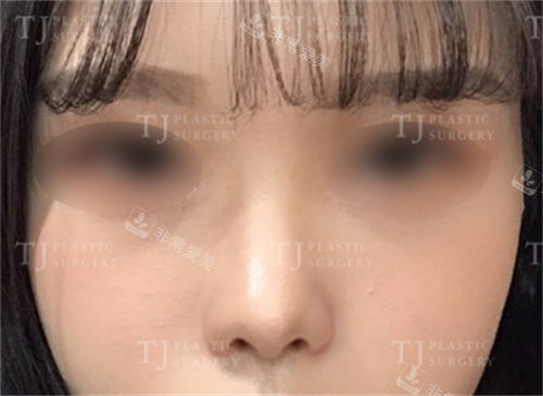 韩国TJ整形外科术后正面照 韩国TJ整形外科术后正面照