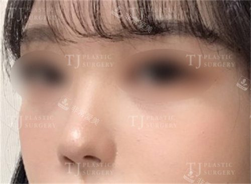 韩国TJ整形外科鼻翼缩小术后照