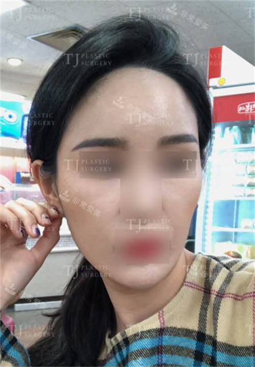 韩国TJ整形外科脂肪填充术前照 韩国TJ整形外科脂肪填充术前照
