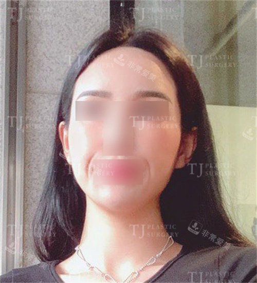 韩国TJ整形外科脂肪填充术前正面照 韩国TJ整形外科脂肪填充术前正面照